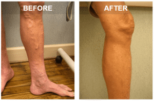 before and after varicose veins in men's legs