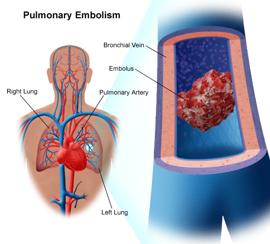 Pulmonary Embolism | Vein Specialists of the South