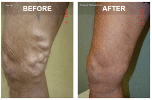 leg health tips to prevent and treat varicose and spider veins