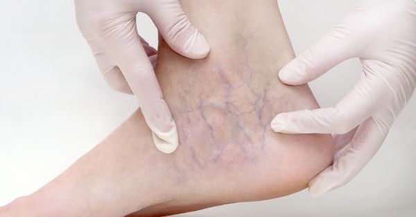 visible spider veins