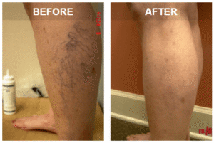 spider veins and varicose veins before and after