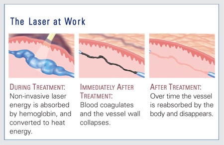 The Laser at Work | Vein Specialists of the South