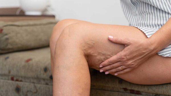 How Does Endovenous Thermal Ablation Work?