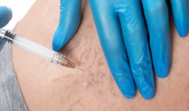 Spider Vein Treatment with Sclerotherapy