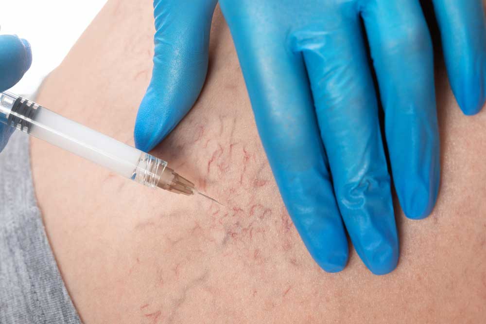 Spider Vein Treatment with Sclerotherapy