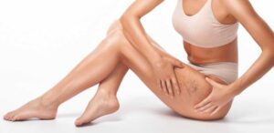 patient with spider veins