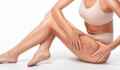 patient with spider veins