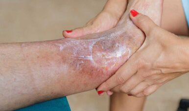 patient venous ulcer treatment