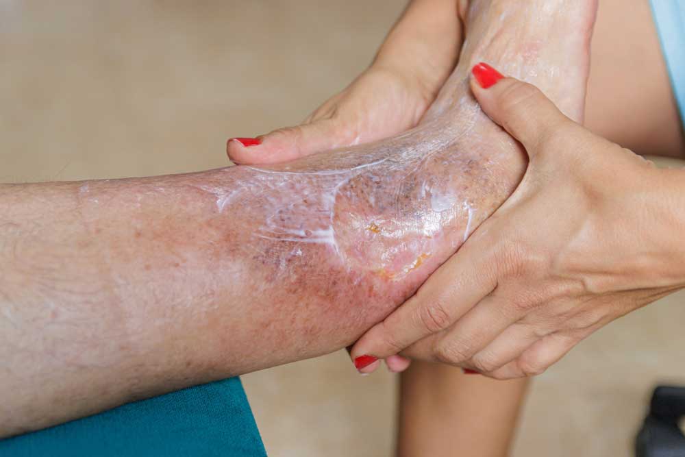patient venous ulcer treatment