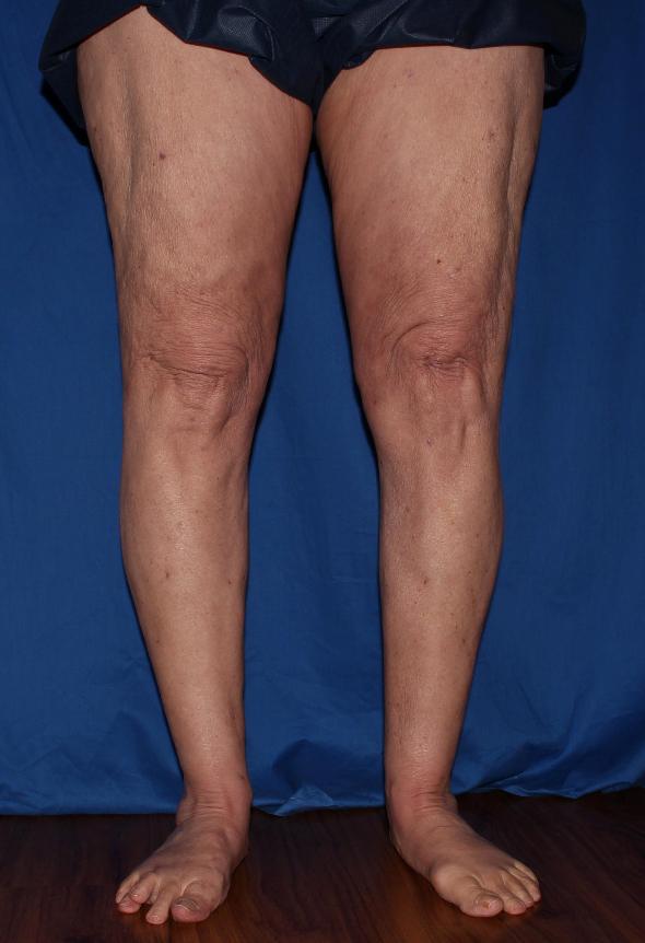 Lymphedema/Swelling Before & After Gallery | Vein Specialists of the South